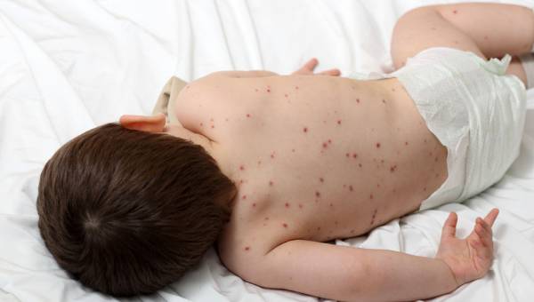 Kızamık salgınına dikkat