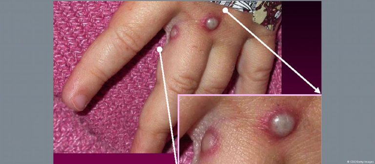 Şimdi de maymun çiçeği bulaşı